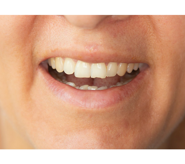 North Richland Hills What Should I Do If I Chip My Tooth