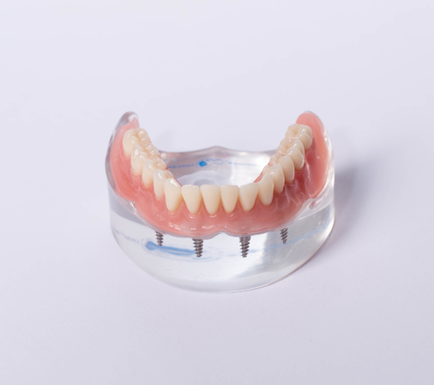 North Richland Hills Implant Supported Dentures